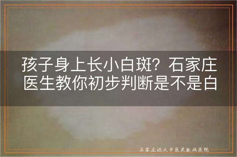 孩子身上长小白斑?石家庄医生教你初步判断是不是白癜风