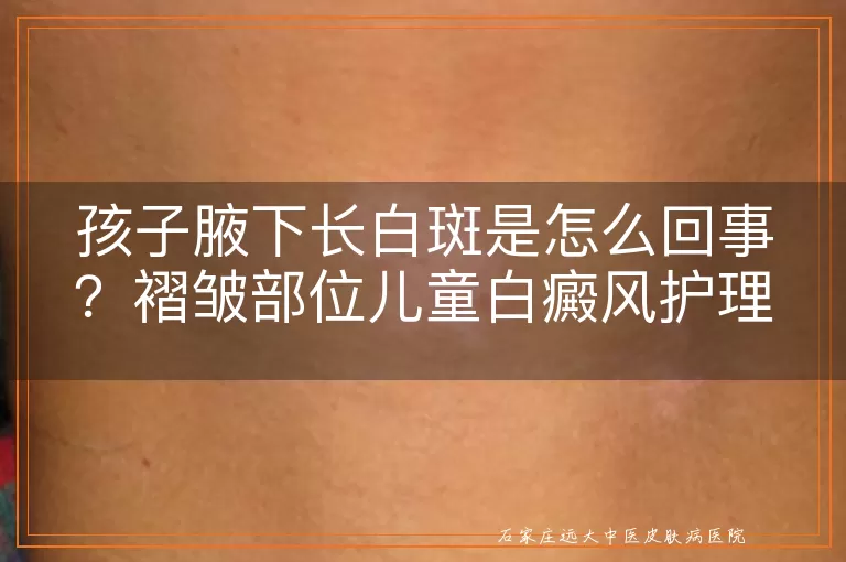 孩子腋下长白斑是怎么回事?褶皱部位儿童白癜风护理要点
