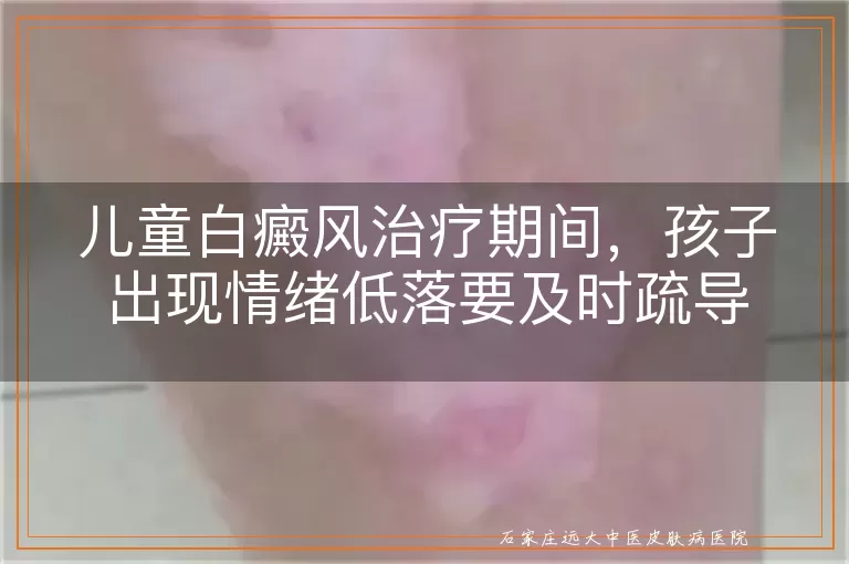 儿童白癜风治疗期间，孩子出现情绪低落要及时疏导