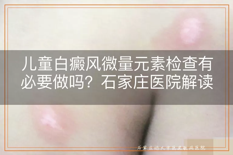 儿童白癜风微量元素检查有必要做吗？石家庄医院解读