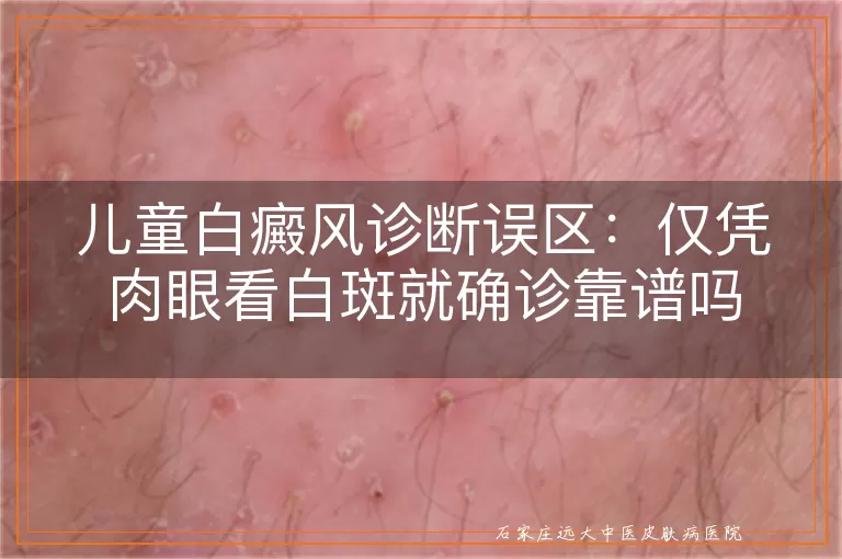 儿童白癜风诊断误区：仅凭肉眼看白斑就确诊靠谱吗