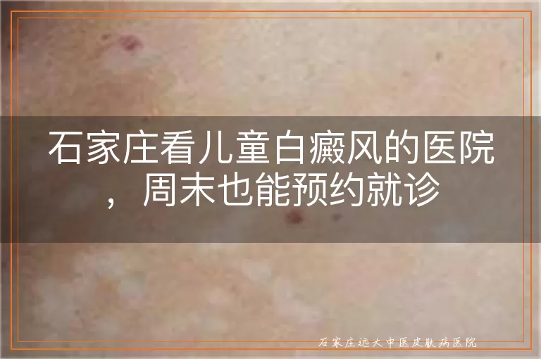 石家庄看儿童白癜风的医院，周末也能预约就诊
