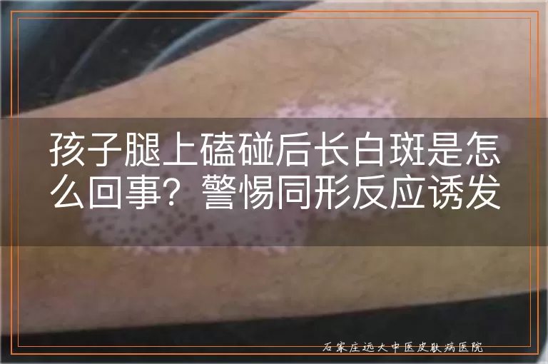 孩子腿上磕碰后长白斑是怎么回事?警惕同形反应诱发白癜风