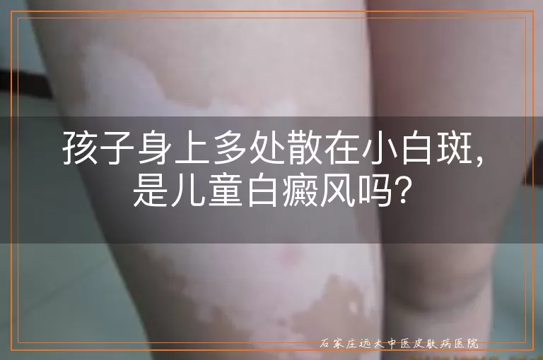 孩子身上多处散在小白斑，是儿童白癜风吗？