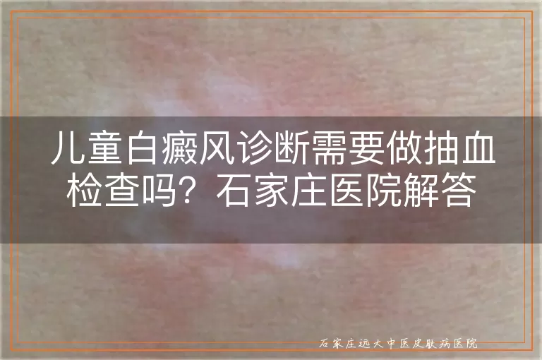 儿童白癜风诊断需要做抽血检查吗？石家庄医院解答