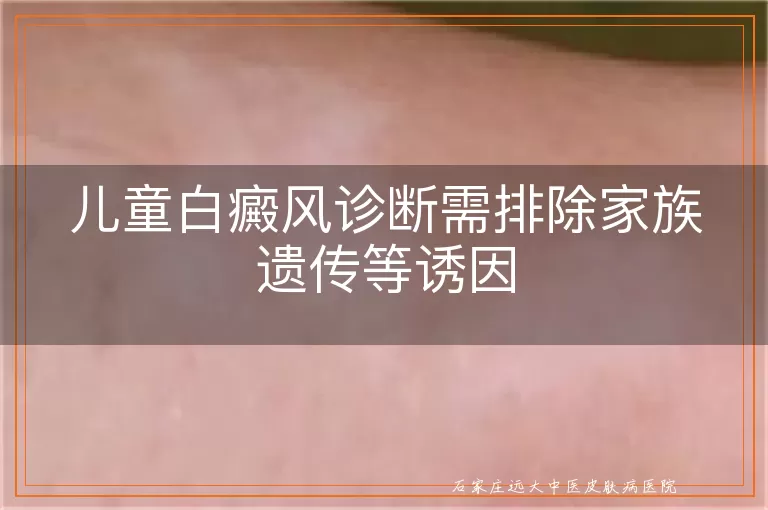 儿童白癜风诊断需排除家族遗传等诱因
