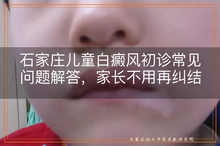 石家庄儿童白癜风初诊常见问题解答，家长不用再纠结