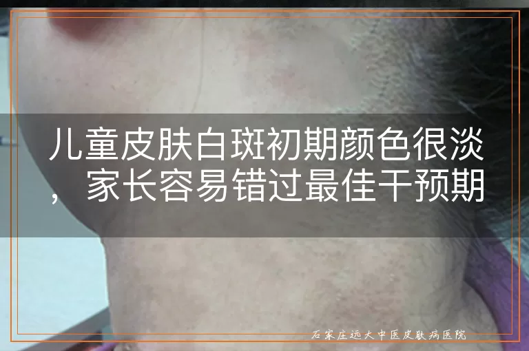 儿童皮肤白斑初期颜色很淡，家长容易错过最佳干预期