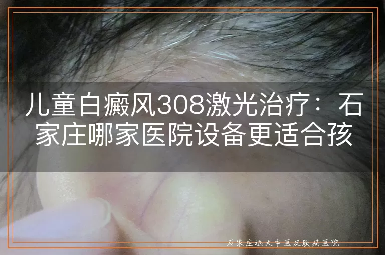 儿童白癜风308激光治疗：石家庄哪家医院设备更适合孩子