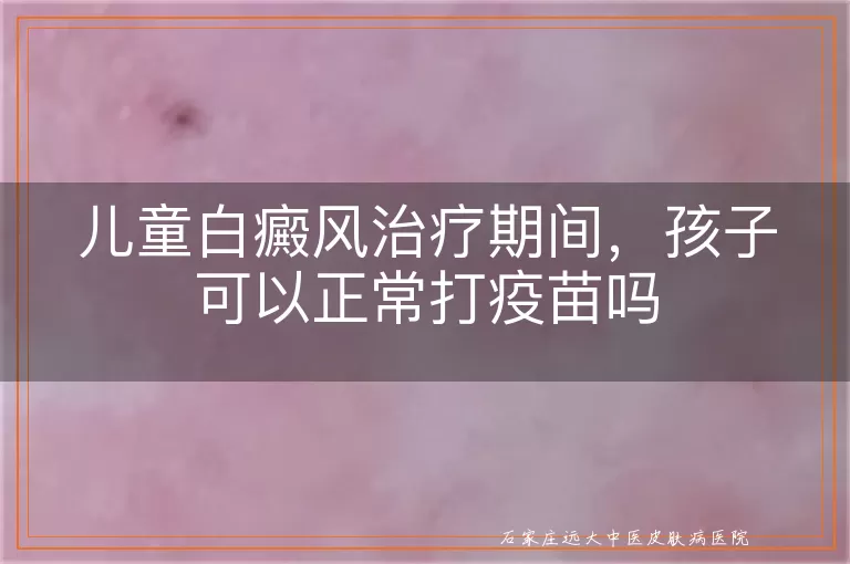儿童白癜风治疗期间，孩子可以正常打疫苗吗