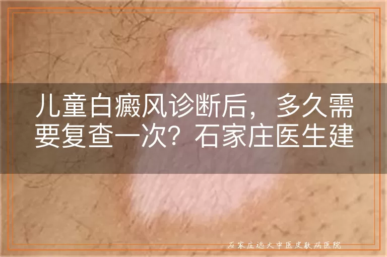 儿童白癜风诊断后，多久需要复查一次？石家庄医生建议