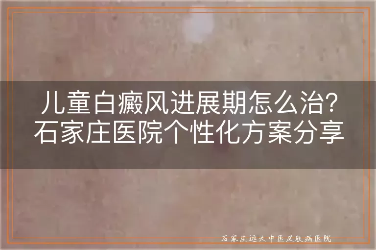 儿童白癜风进展期怎么治？石家庄医院个性化方案分享