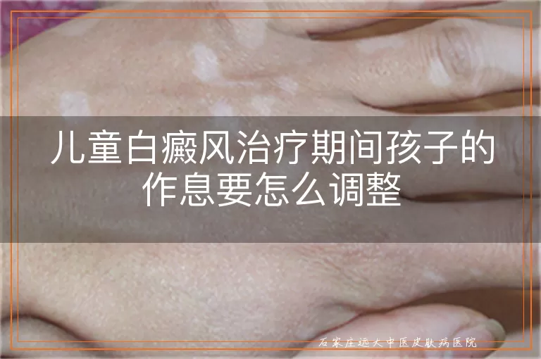儿童白癜风治疗期间孩子的作息要怎么调整