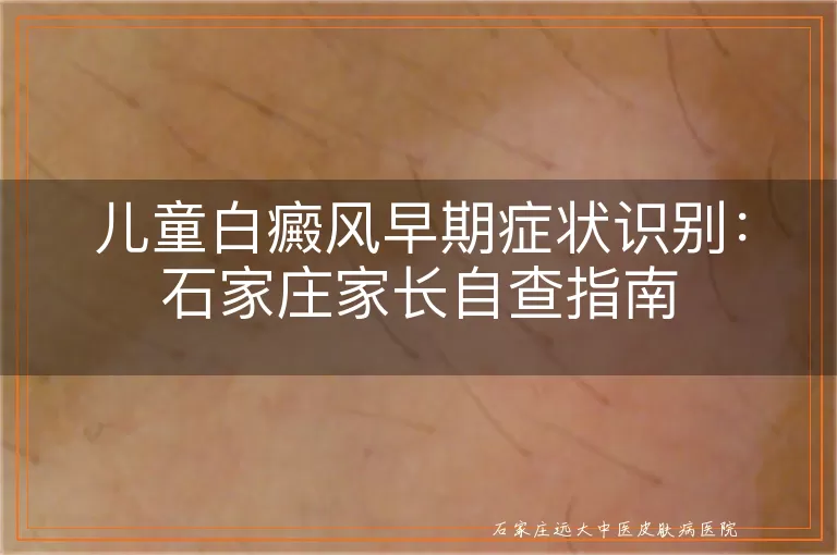 儿童白癜风早期症状识别：石家庄家长自查指南