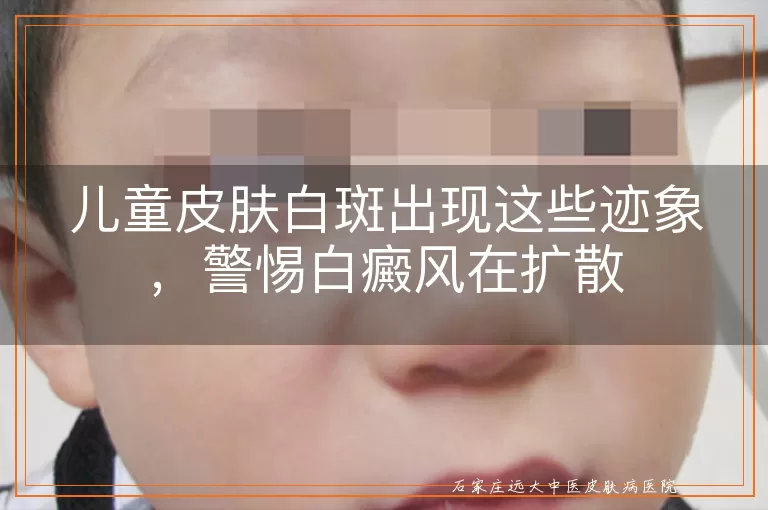 儿童皮肤白斑出现这些迹象，警惕白癜风在扩散