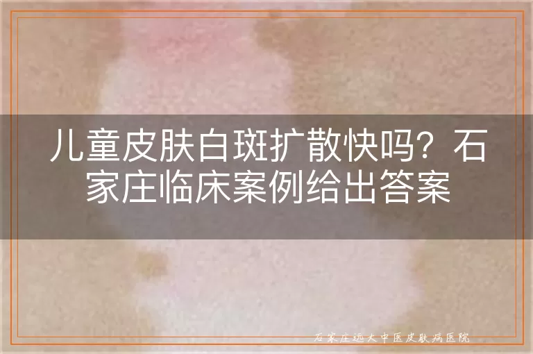 儿童皮肤白斑扩散快吗？石家庄临床案例给出答案