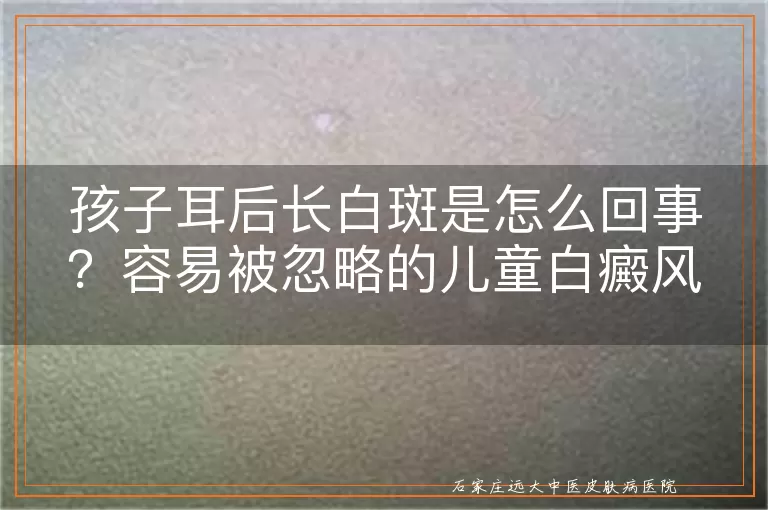 孩子耳后长白斑是怎么回事？容易被忽略的儿童白癜风部位