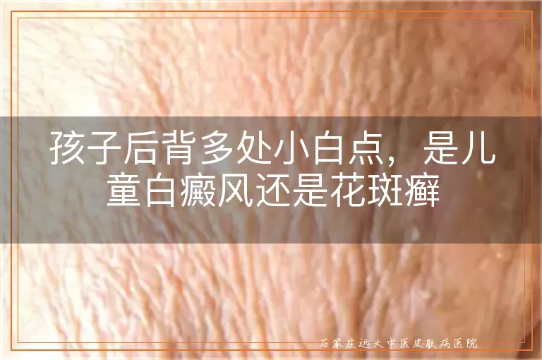 孩子后背多处小白点，是儿童白癜风还是花斑癣