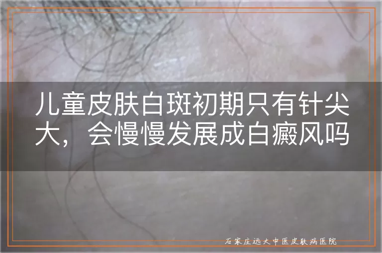 儿童皮肤白斑初期只有针尖大，会慢慢发展成白癜风吗