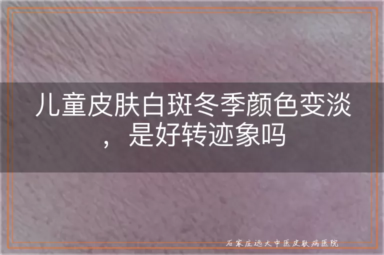 儿童皮肤白斑冬季颜色变淡，是好转迹象吗