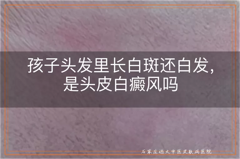 孩子头发里长白斑还白发，是头皮白癜风吗
