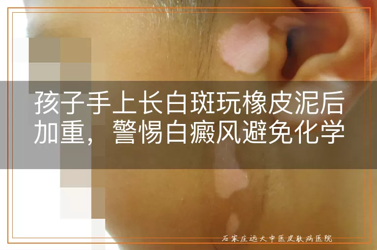 孩子手上长白斑玩橡皮泥后加重，警惕白癜风避免化学刺激