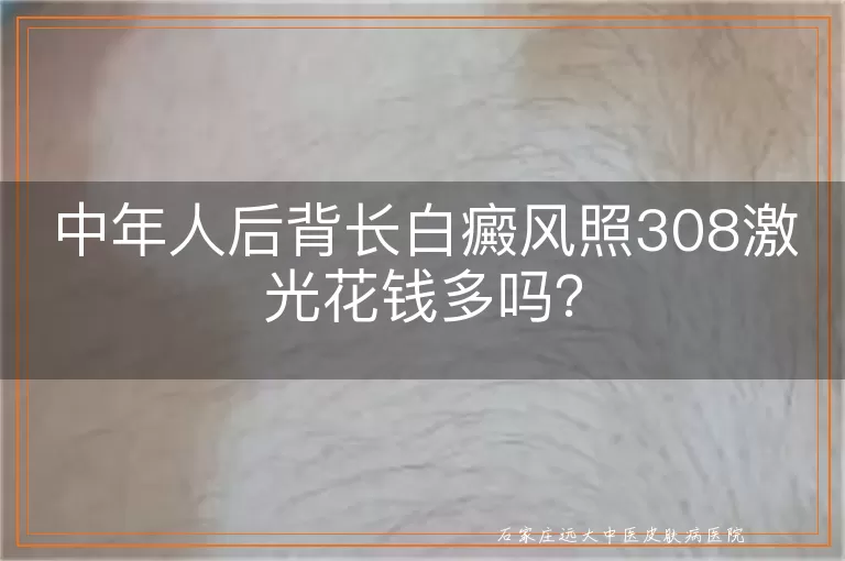 中年人后背长白癜风照308激光花钱多吗？