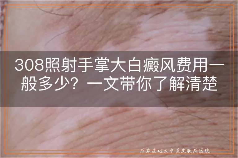 308照射手掌大白癜风费用一般多少？一文带你了解清楚！