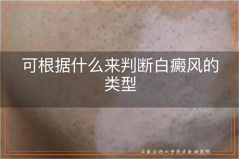 可根据什么来判断白癜风的类型