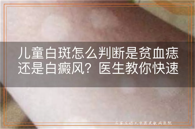 儿童白斑怎么判断是贫血痣还是白癜风?医生教你快速区分