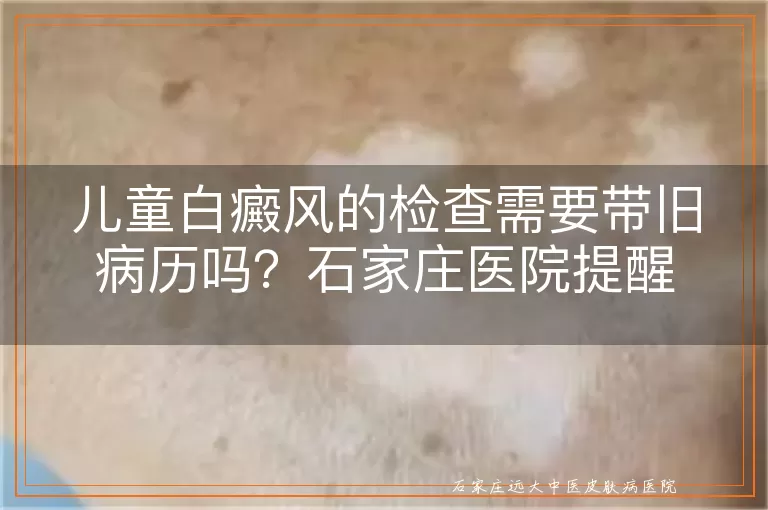 儿童白癜风的检查需要带旧病历吗？石家庄医院提醒
