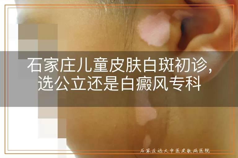 石家庄儿童皮肤白斑初诊,选公立还是白癜风专科