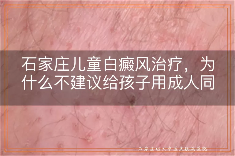 石家庄儿童白癜风治疗，为什么不建议给孩子用成人同款药物