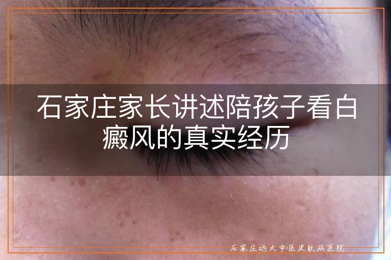 石家庄家长讲述陪孩子看白癜风的真实经历