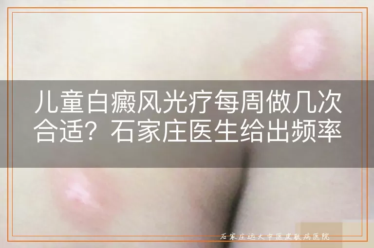 儿童白癜风光疗每周做几次合适?石家庄医生给出频率