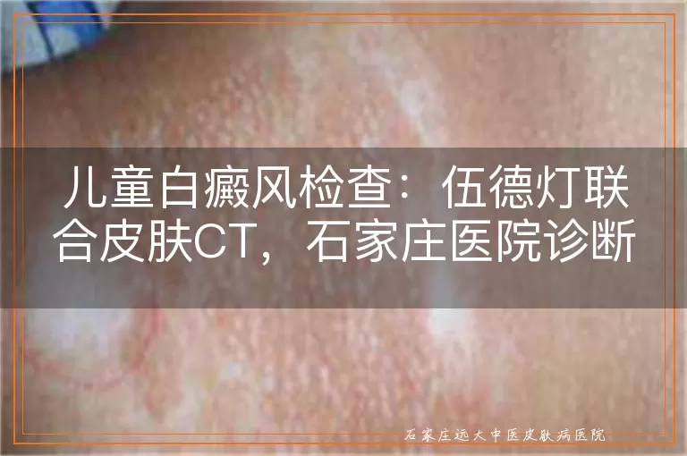儿童白癜风检查:伍德灯联合皮肤CT,石家庄医院诊断更准