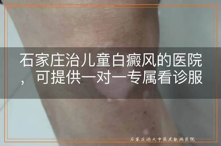 石家庄治儿童白癜风的医院，可提供一对一专属看诊服务