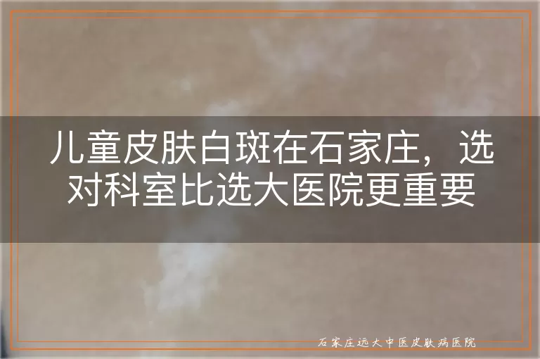 儿童皮肤白斑在石家庄,选对科室比选大医院更重要