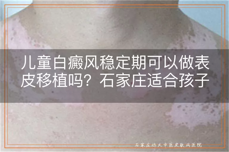 儿童白癜风稳定期可以做表皮移植吗？石家庄适合孩子的医院怎么选