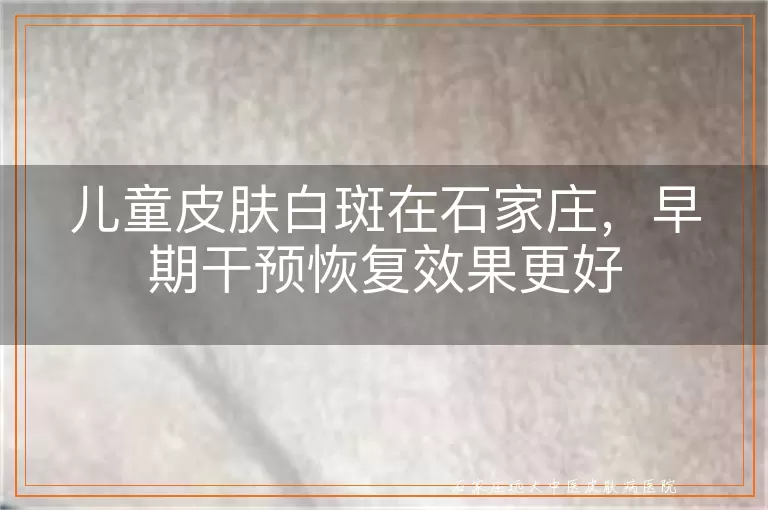 儿童皮肤白斑在石家庄，早期干预恢复效果更好