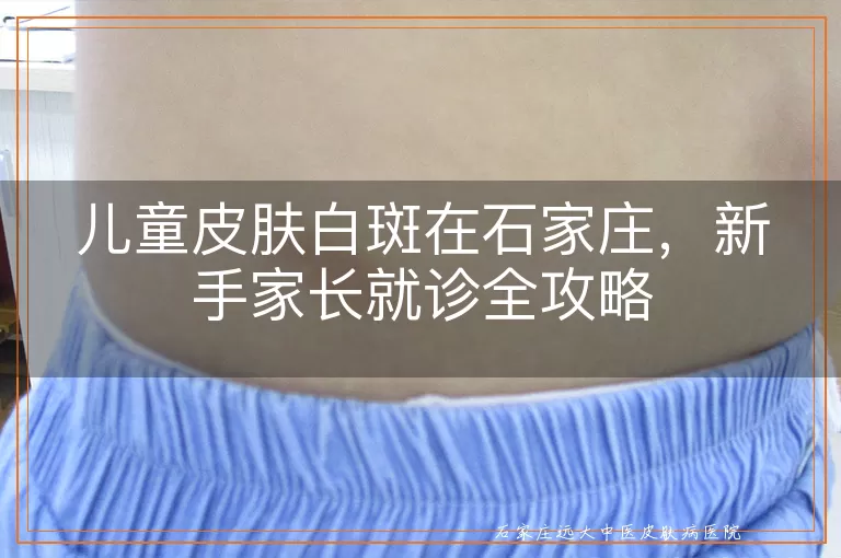 儿童皮肤白斑在石家庄，新手家长就诊全攻略