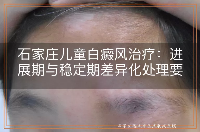 石家庄儿童白癜风治疗：进展期与稳定期差异化处理要点