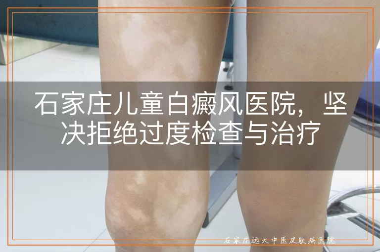 石家庄儿童白癜风医院,坚决拒绝过度检查与治疗