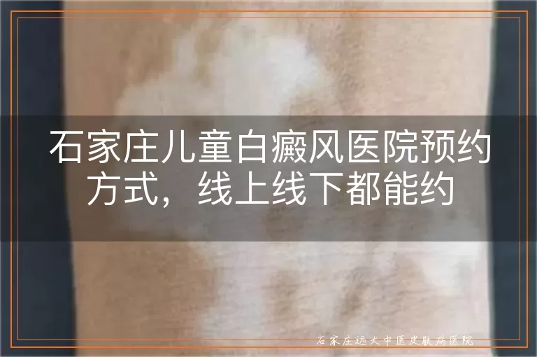 石家庄儿童白癜风医院预约方式，线上线下都能约