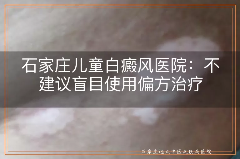 石家庄儿童白癜风医院：不建议盲目使用偏方治疗