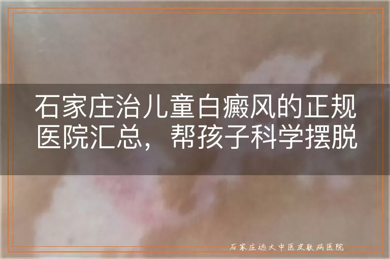 石家庄治儿童白癜风的正规医院汇总，帮孩子科学摆脱白斑困扰