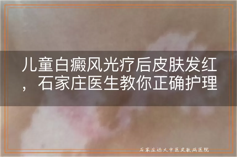 儿童白癜风光疗后皮肤发红，石家庄医生教你正确护理