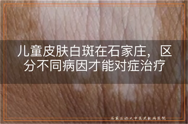 儿童皮肤白斑在石家庄，区分不同病因才能对症治疗