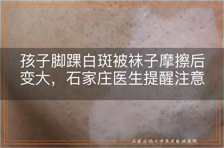 孩子脚踝白斑被袜子摩擦后变大，石家庄医生提醒注意这几点