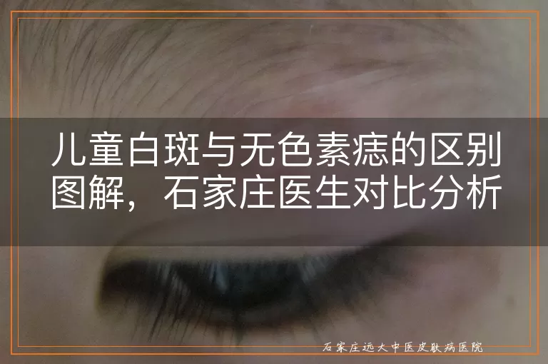 儿童白斑与无色素痣的区别图解，石家庄医生对比分析